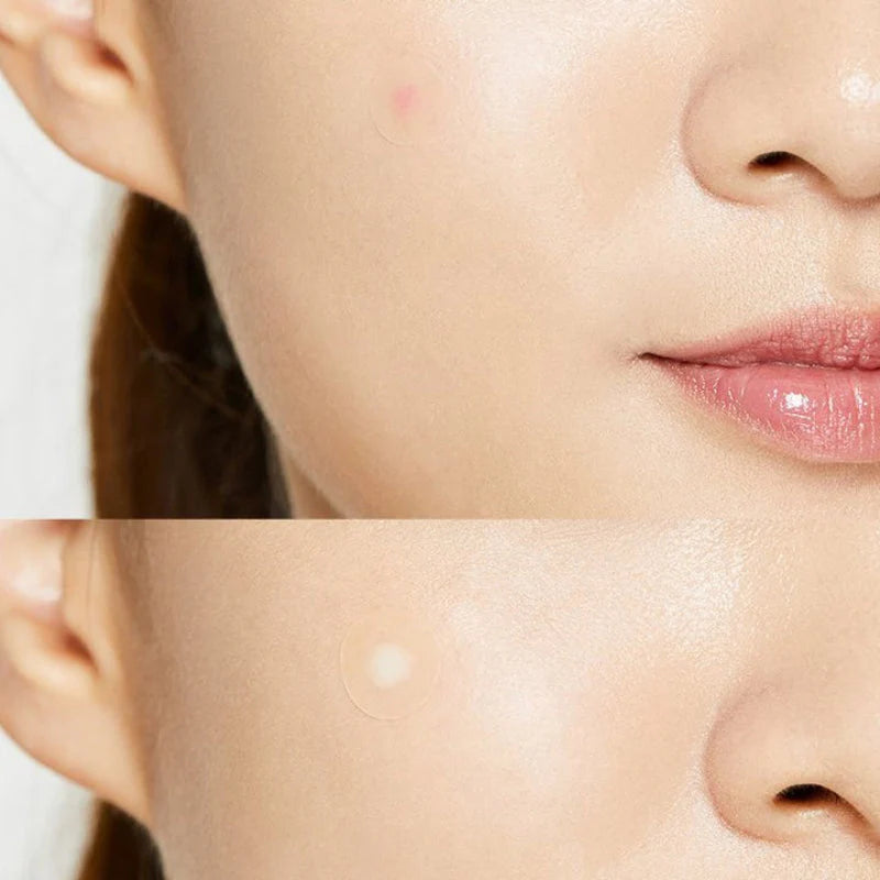 COSRX - Acne Pimple Master Patch - GA HEADHOUSE